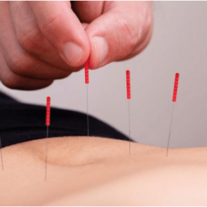 Accupuncture Therapy