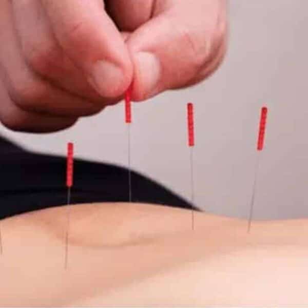 Acupuncture Therapy Not Available